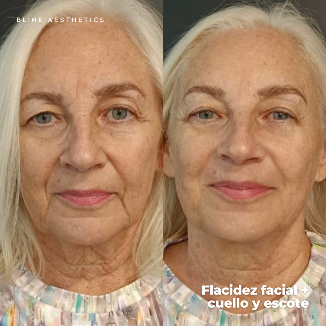 Ultrasonic 9D · Lifting Facial
