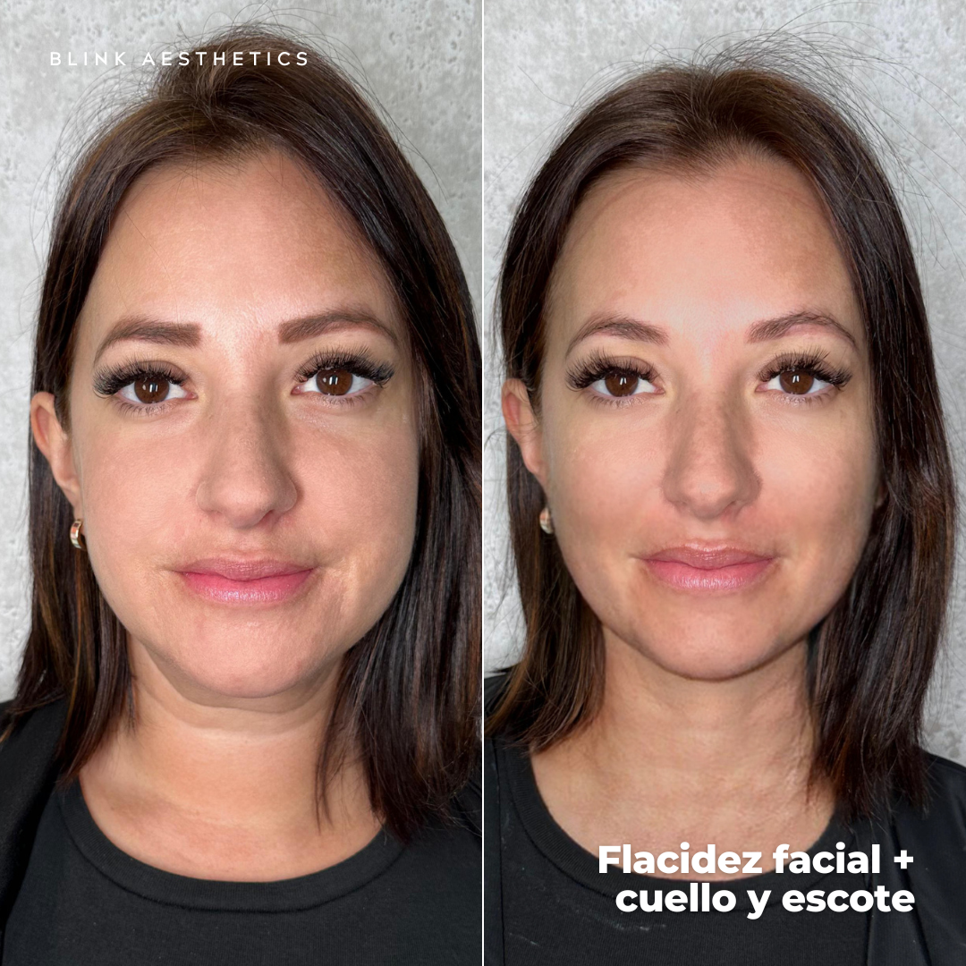 Ultrasonic 9D · Lifting Facial