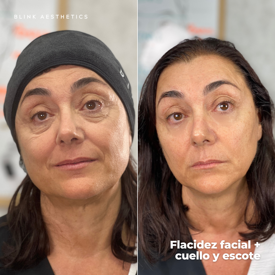 Ultrasonic 9D · Lifting Facial