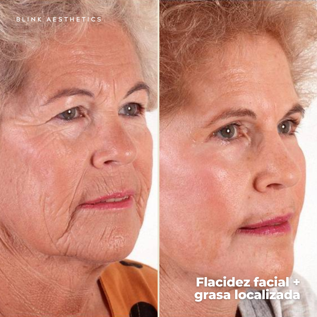 Ultrasonic 9D · Lifting Facial