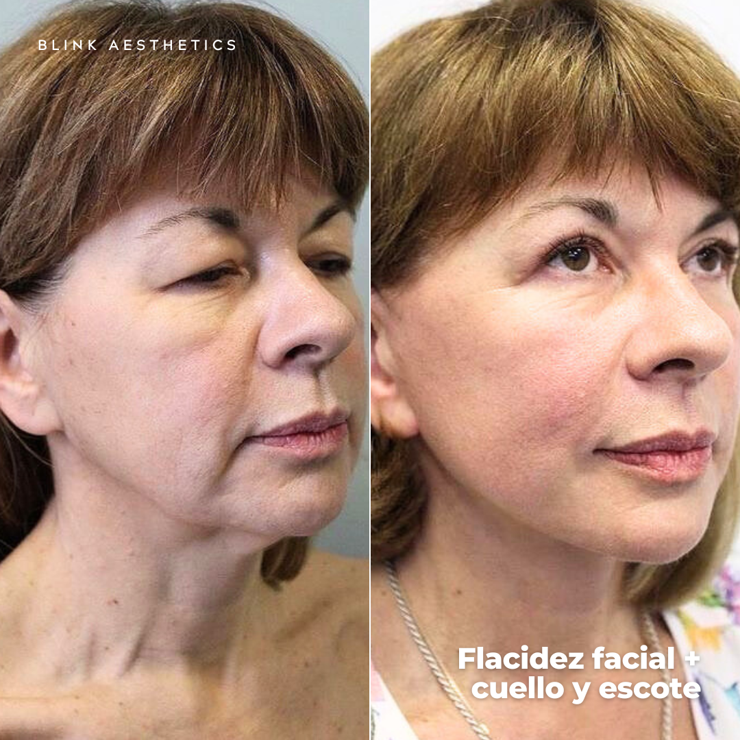 Ultrasonic 9D · Lifting Facial