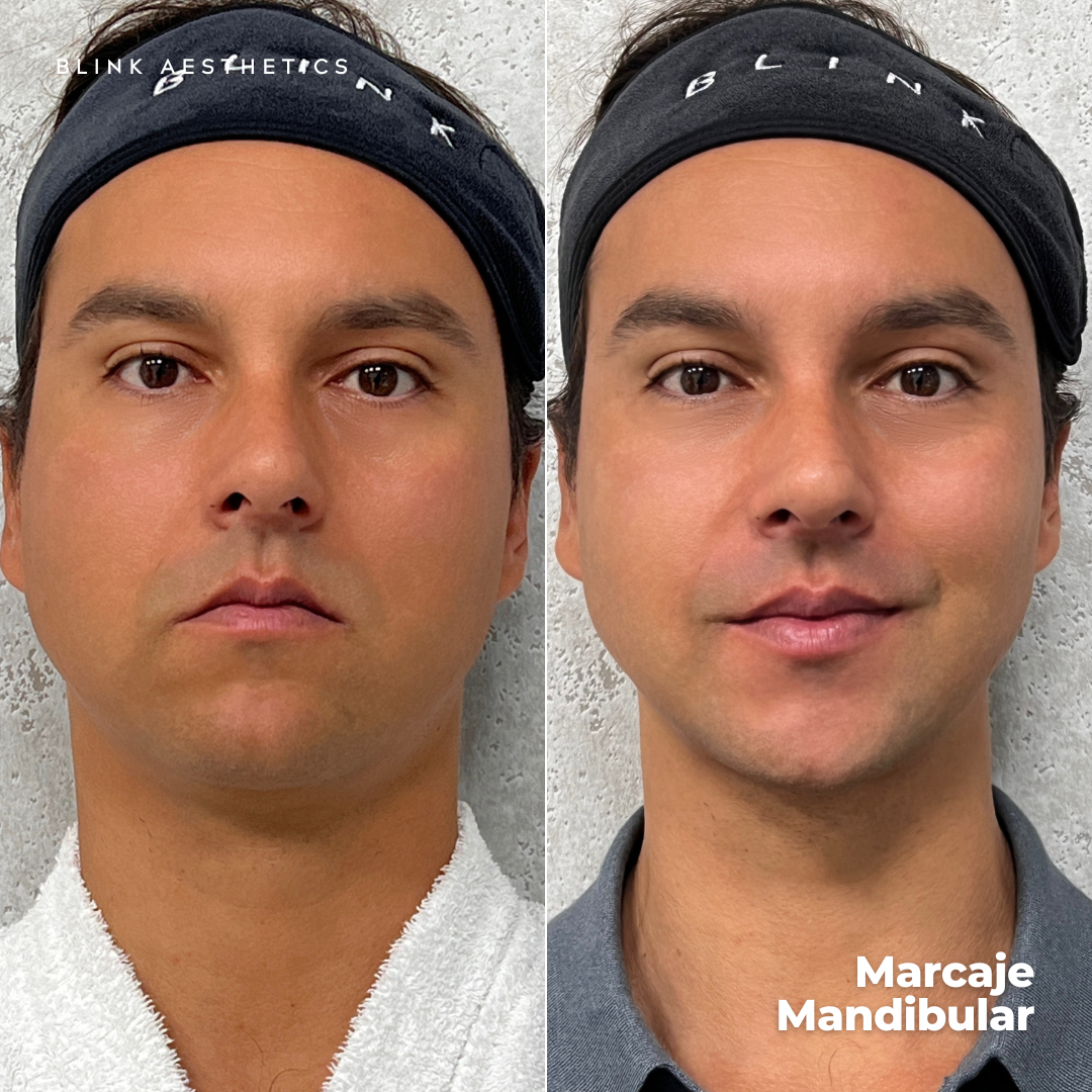 Ultrasonic 9D · Lifting Facial