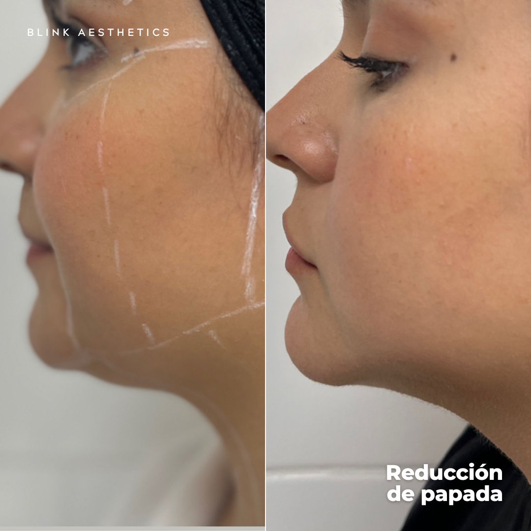 Ultrasonic 9D · Lifting Facial
