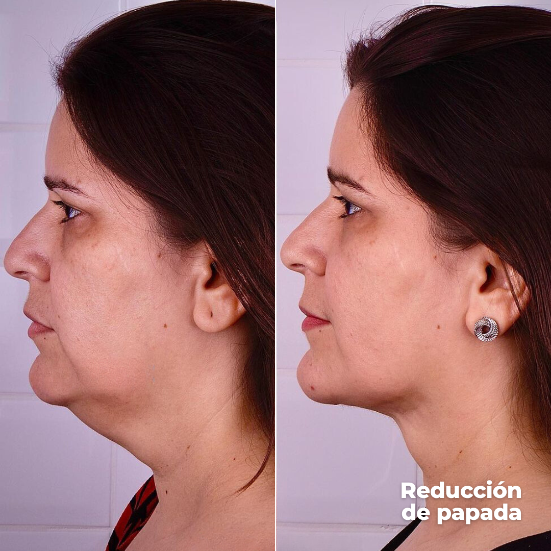 Ultrasonic 9D · Lifting Facial