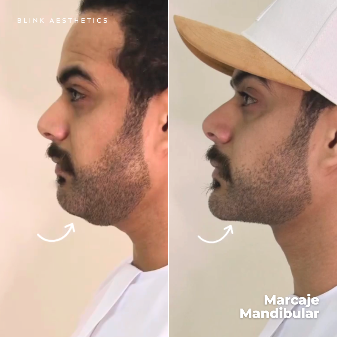 Ultrasonic 9D · Lifting Facial