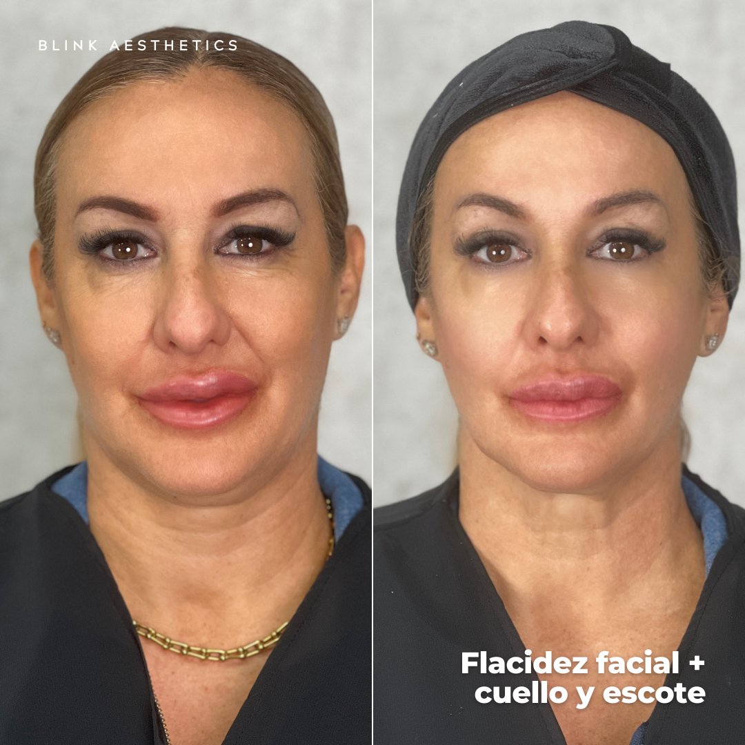 Ultrasonic 9D · Lifting Facial