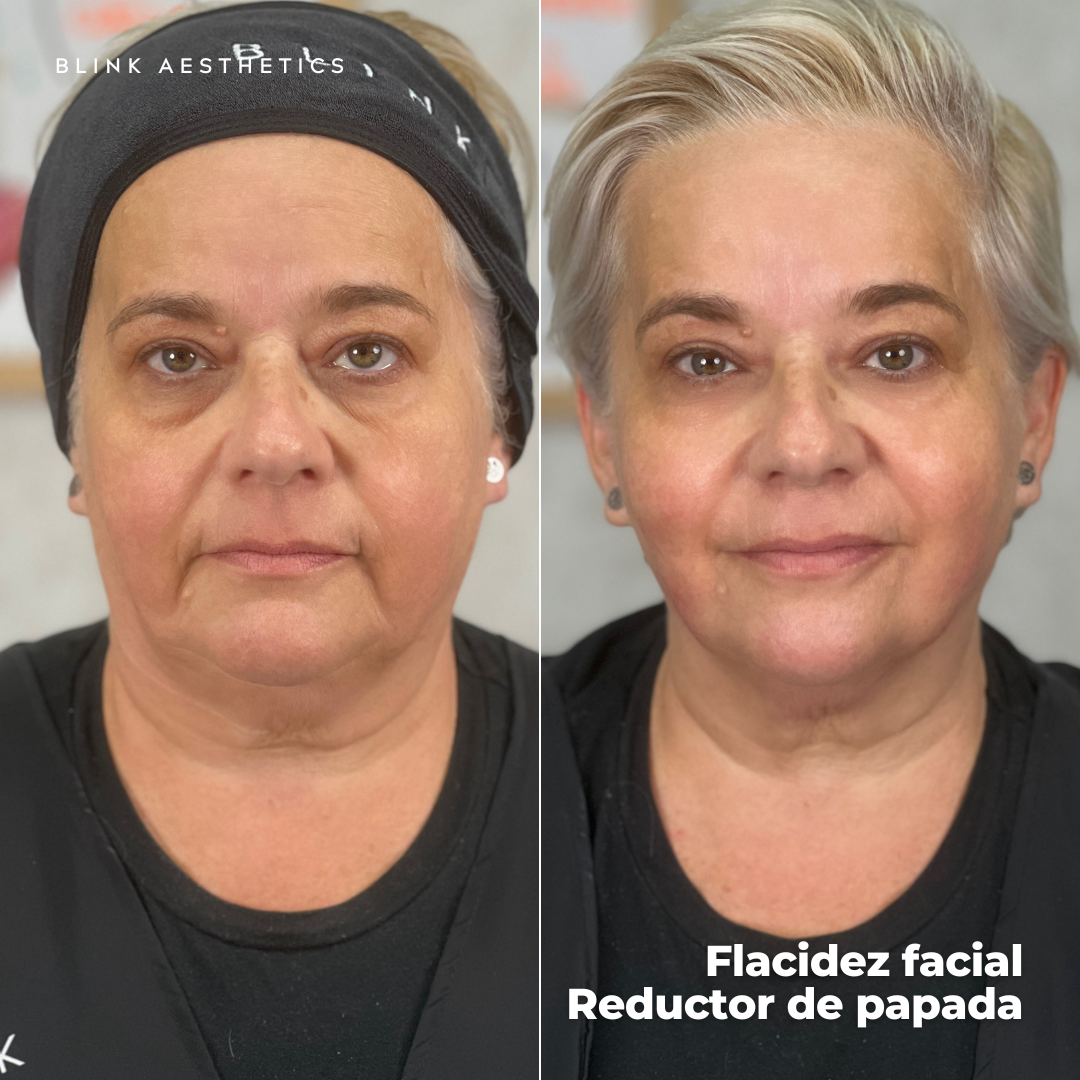 Ultrasonic 9D · Lifting Facial