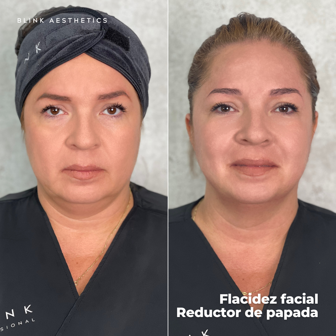 Ultrasonic 9D · Lifting Facial