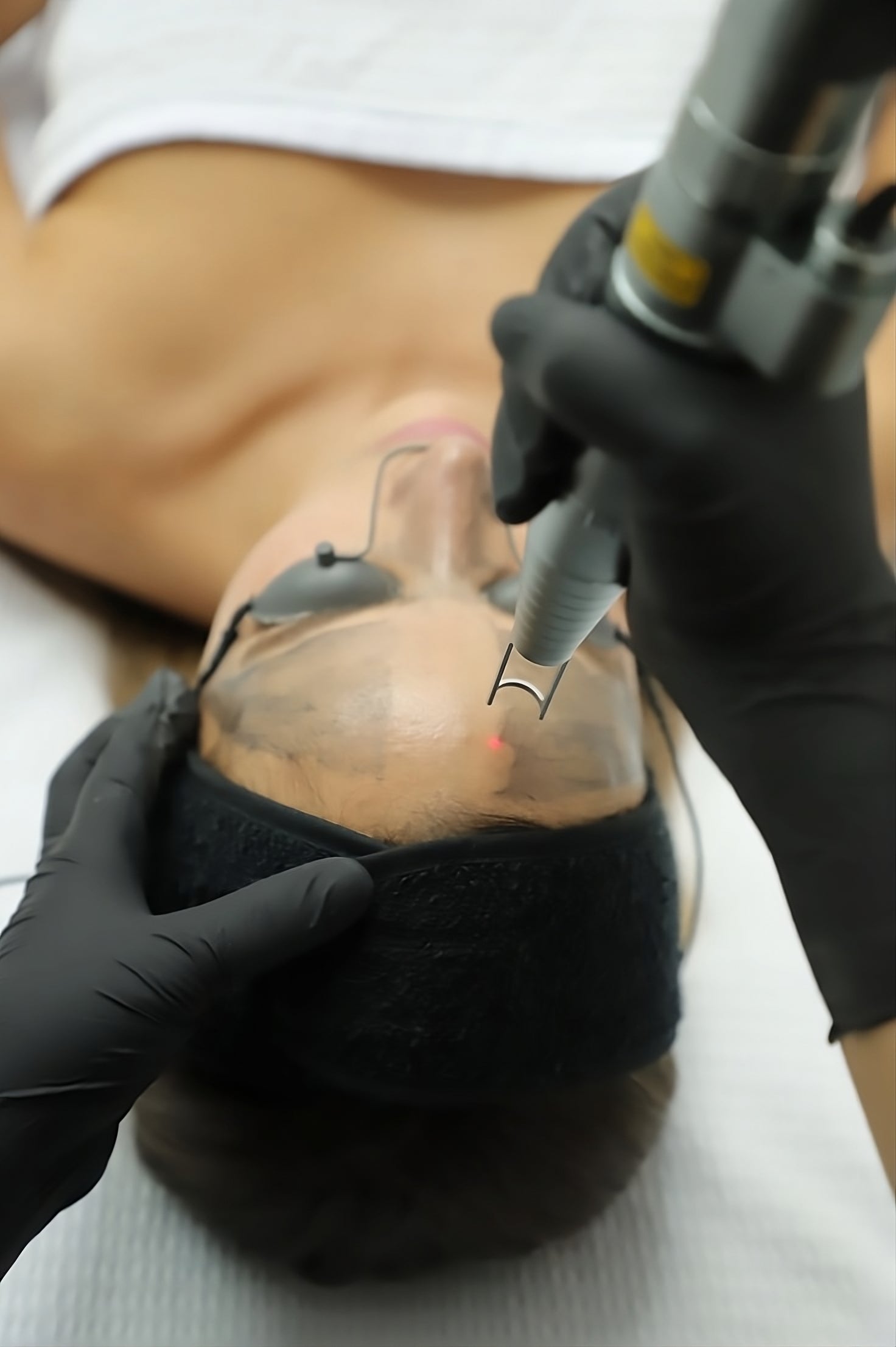 Laser Peel Carbono OFERTA FLASH