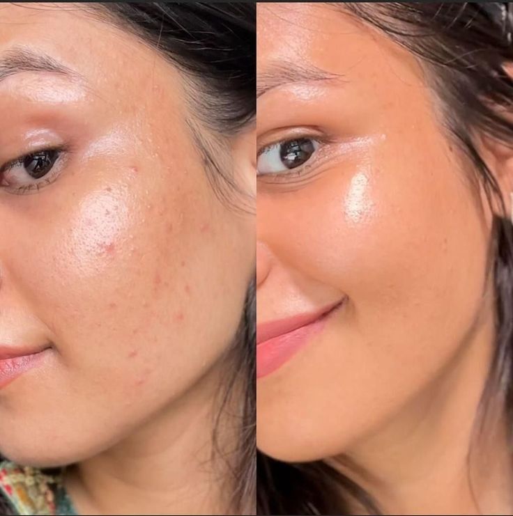 Micro Facial  OFERTA FLASH