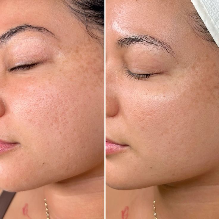 Micro Facial  OFERTA FLASH