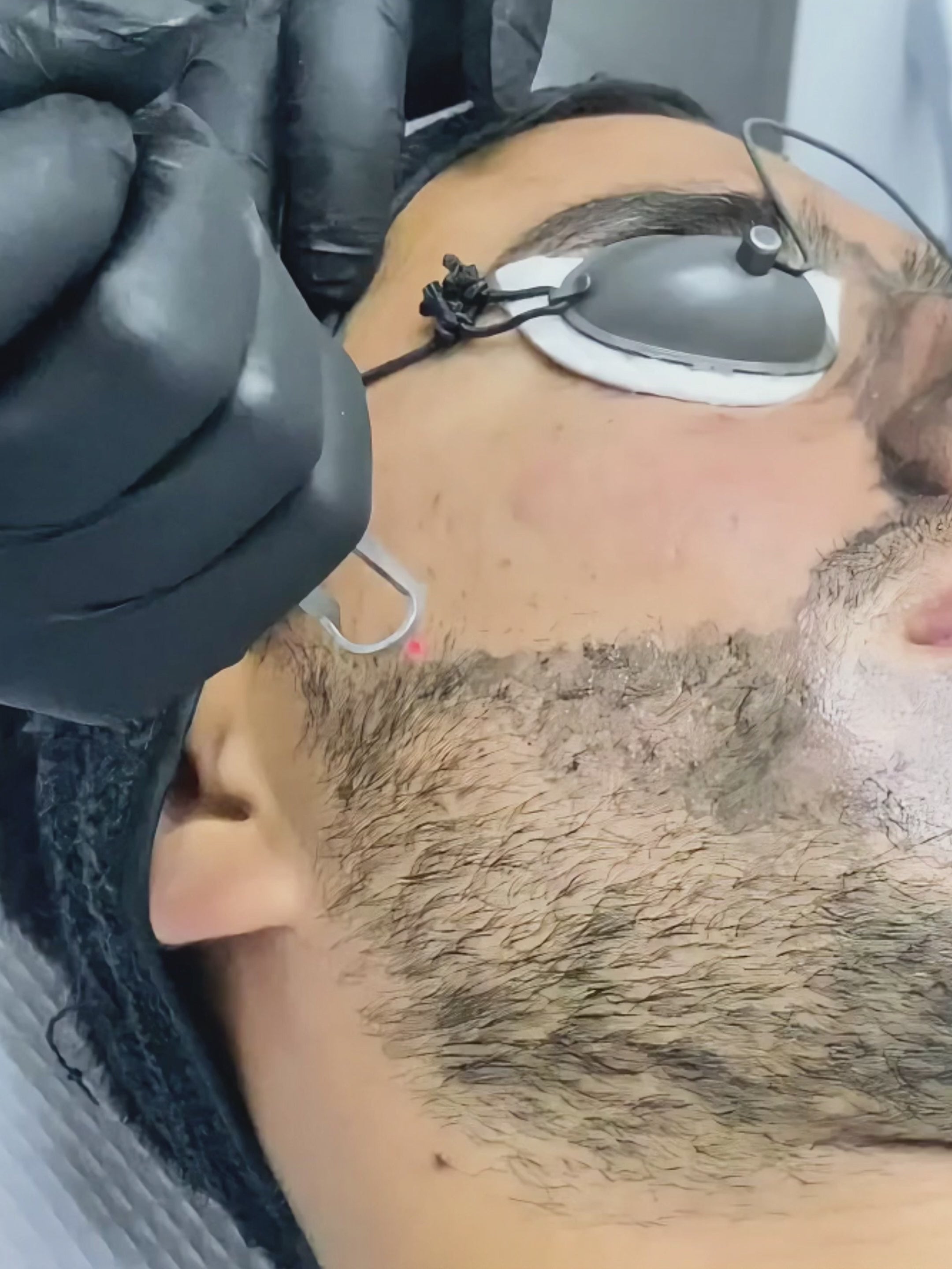 Laser Peel Carbono OFERTA FLASH