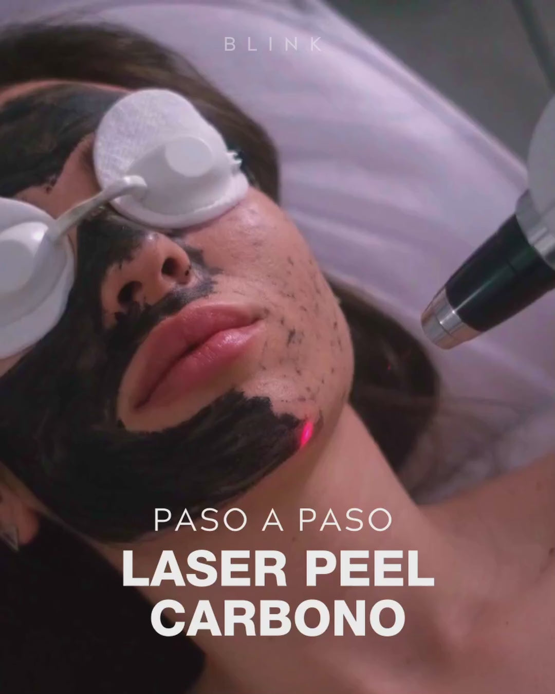 Laser Peel Carbono OFERTA FLASH