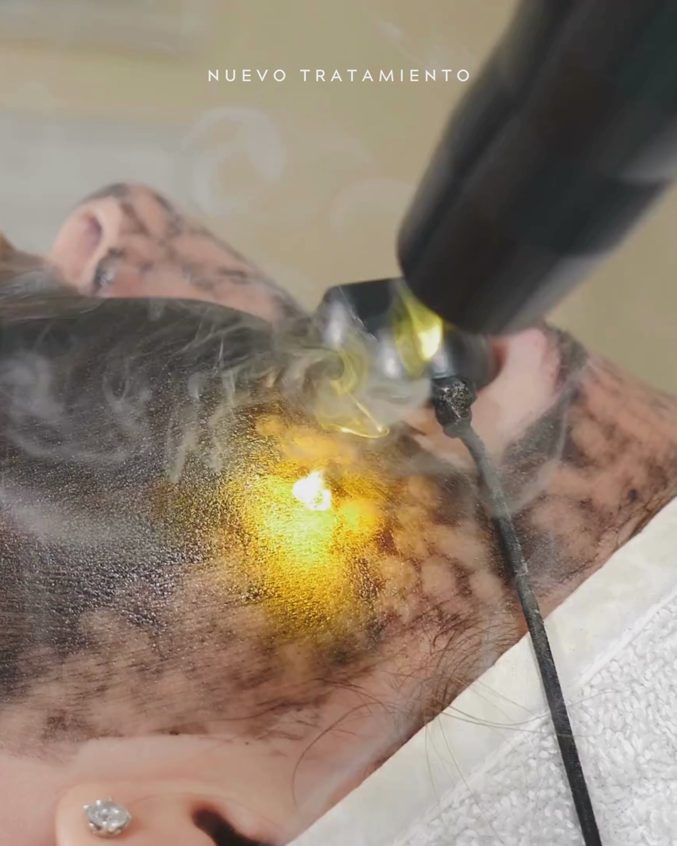 Laser Peel Carbono OFERTA FLASH