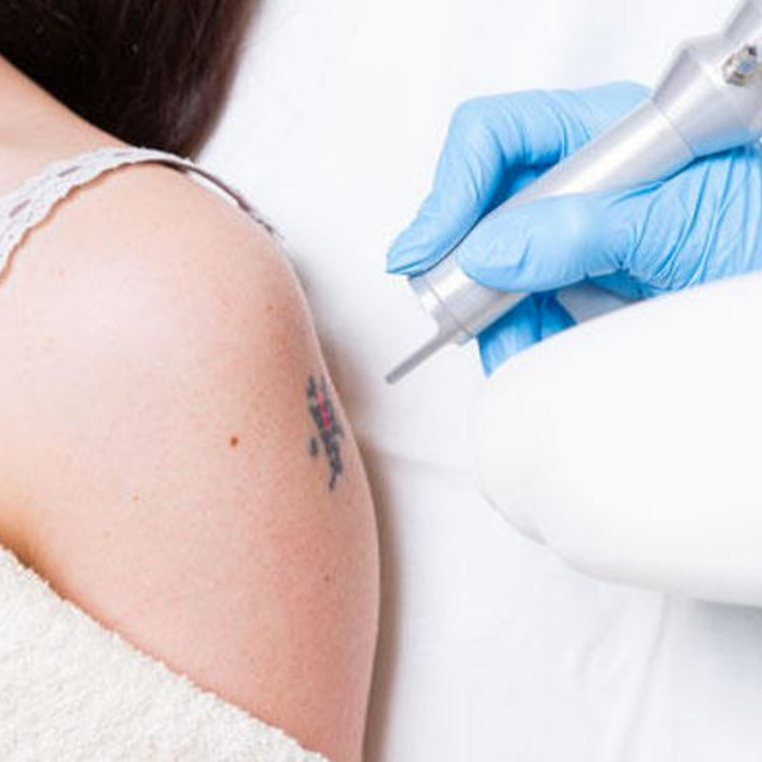 Eliminación de Tatuaje